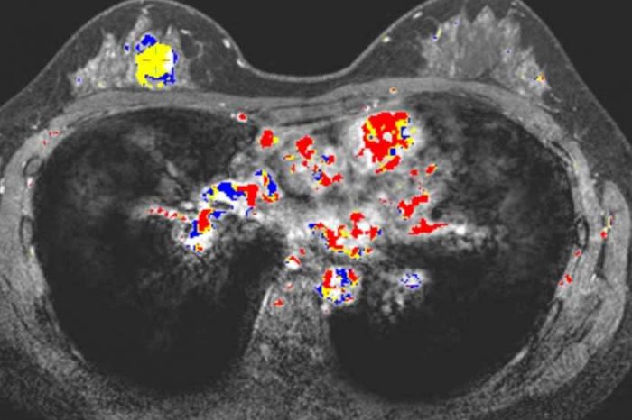 Paragon Biosciences launches Qlarity Imaging to advance QuantX, the first AI breast cancer diagnostic tool to get FDA clearance