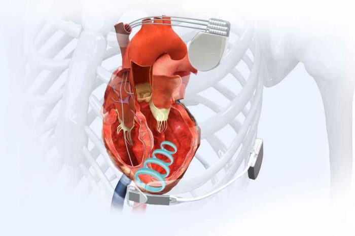 Health tech startup EBR Systems lands $30 million to prepare for commercialization of its WiSE Cardiac Resynchronization Therapy (CRT) System, the world's only wireless cardiac pacing system